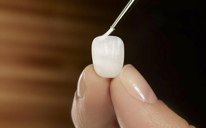 Микропротезирование (виниры, вкладки, накладки)