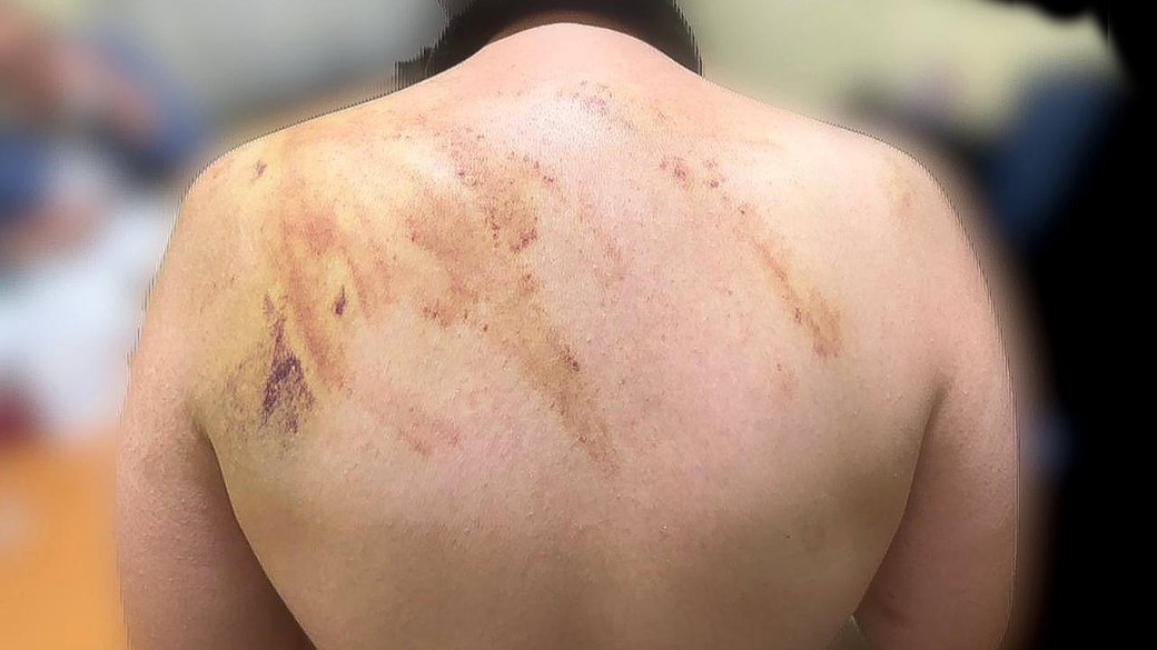 Наслідки побиття в коломийському інтернаті / Фото: Дмитро Лубінець