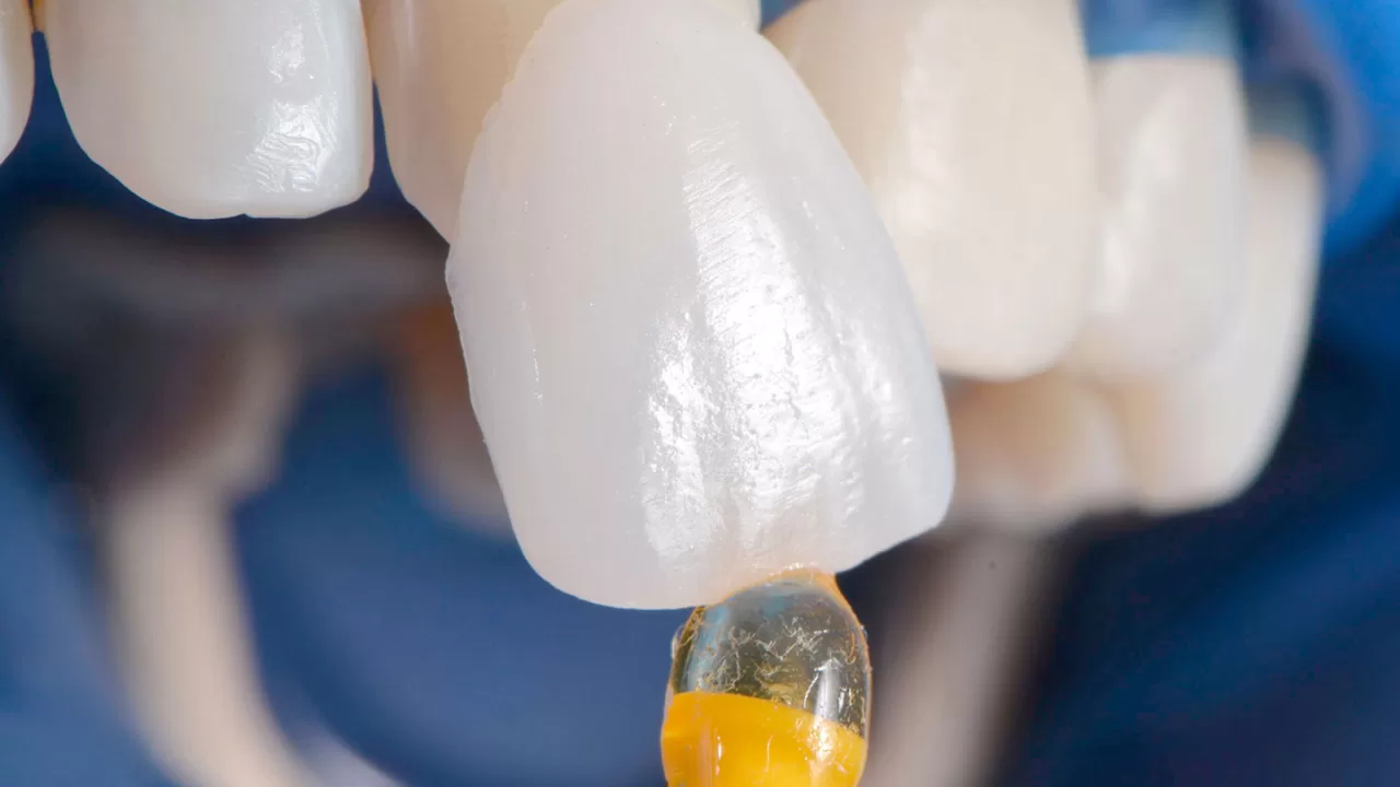 ціна вінірів у Києві